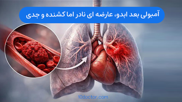 آمبولی بعد ابدو، عارضه ای نادر اما کشنده و جدی