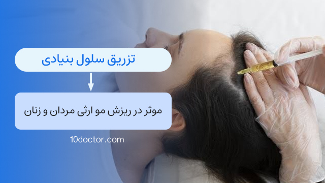 تزریق سلول بنیادی موثر در ریزش مو ارثی مردان و زنان
