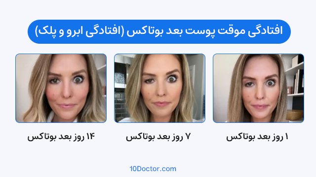 افتادگی موقت پوست بعد بوتاکس (افتادگی ابرو و پلک)