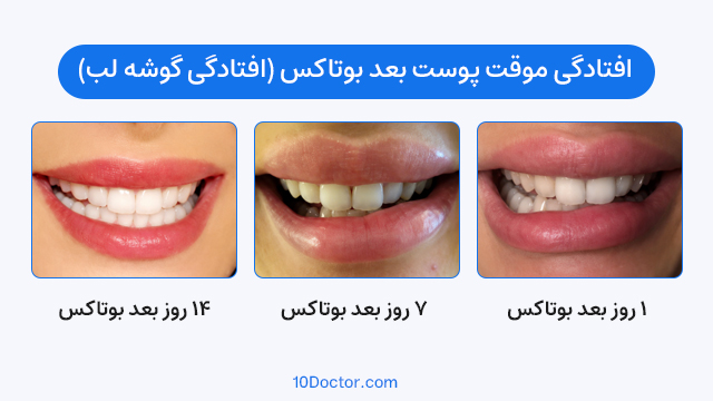 افتادگی موقت پوست بعد بوتاکس (افتادگی گوشه لب)