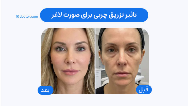 تاثیر تزریق چربی برای صورت لاغر