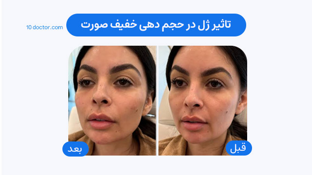 تاثیر ژل در حجم دهی خفیف صورت