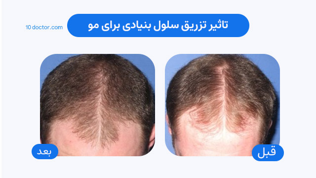تاثیر تزریق سلول بنیادی برای مو - عکس قبل و بعد