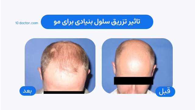 تاثیر تزریق سلول بنیادی برای مو - عکس قبل و بعد