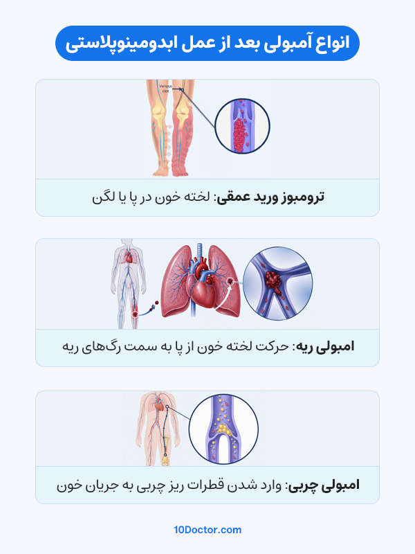 انواع امبولی بعد از عمل ابدومینوپلاستی