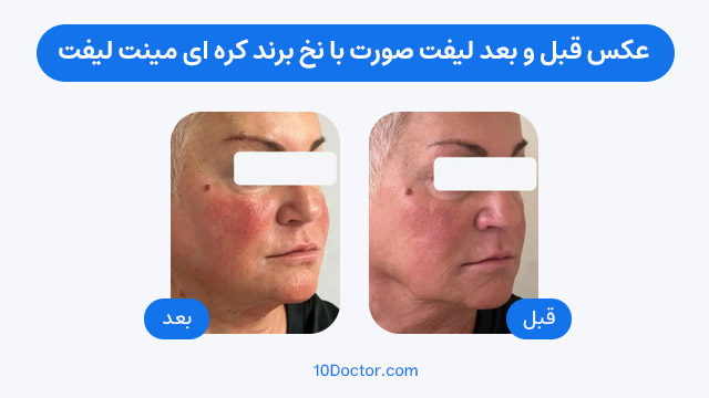 عکس قبل و بعد لیفت صورت با نخ برند اروپایی سیلوئت