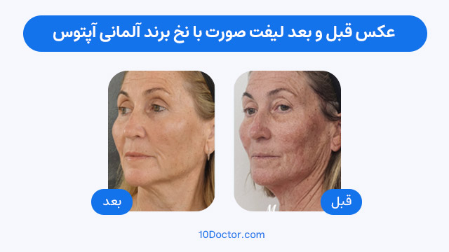 عکس قبل و بعد لیفت صورت با نخ برند آلمانی آپتوس