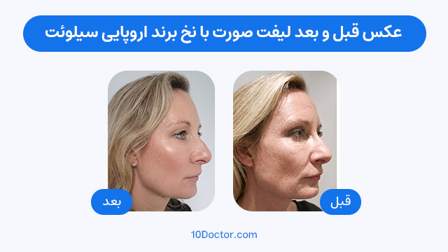عکس قبل و بعد لیفت صورت با نخ برند کره ای مینت لیفت