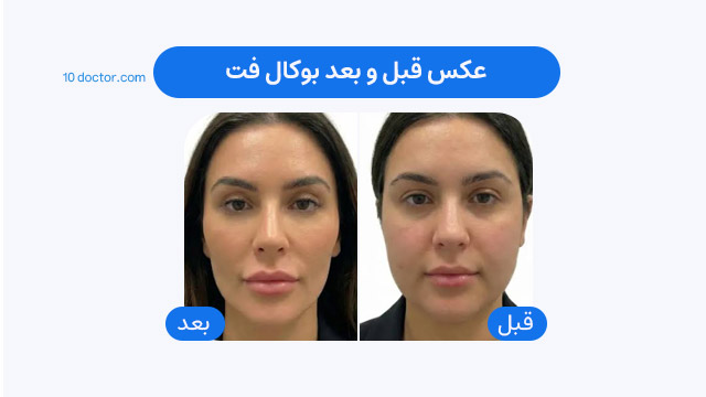 عکس قبل و بعد بوکال فت