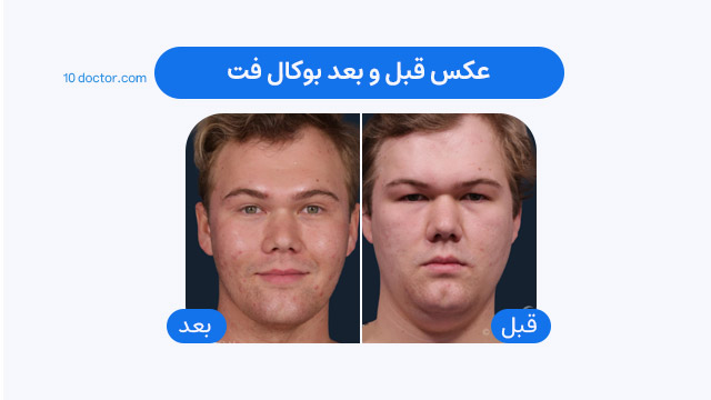 عکس قبل و بعد بوکال فت