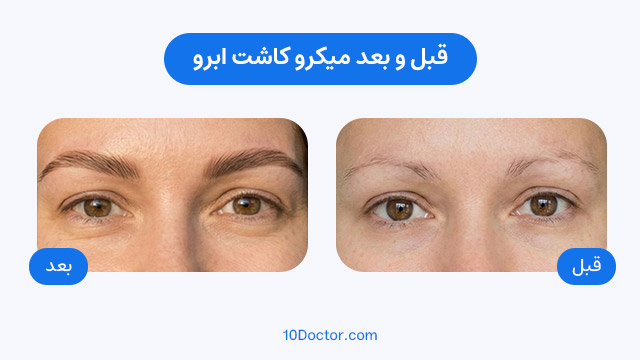 عکس قبل و بعد میکرو کاشت ابرو 