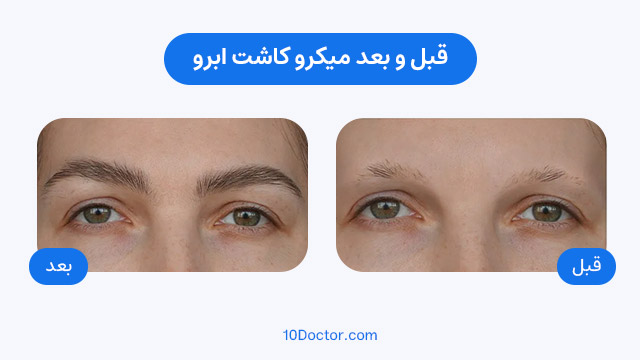 عکس قبل و بعد میکرو کاشت ابرو 