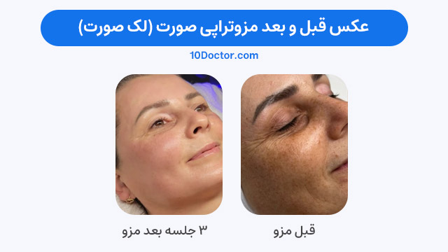 عکس قبل و بعد مزوتراپی صورت (برای لک صورت)