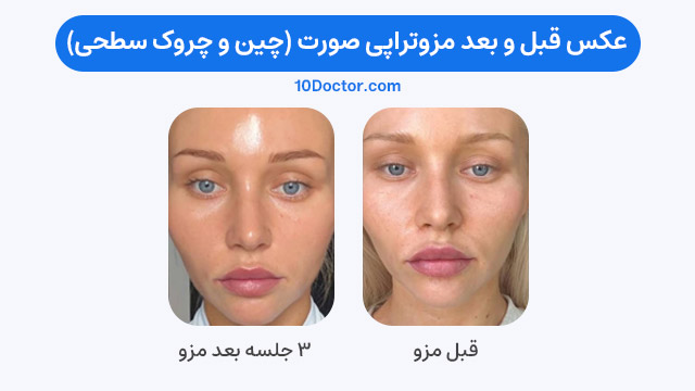 عکس قبل و بعد مزوتراپی صورت (برای چین و چروک سطحی)