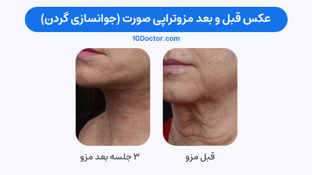 عکس قبل و بعد مزوتراپی صورت (برای جوانسازی گردن)