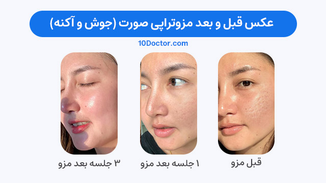 عکس قبل و بعد مزوتراپی صورت (برای جوش و آکنه)