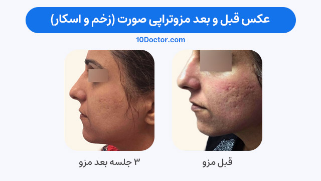 عکس قبل و بعد مزوتراپی صورت (برای زخم و اسکار)