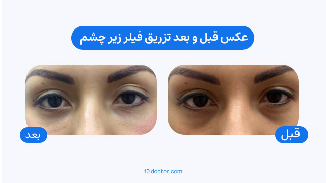 عکس قبل و بعد تزریق فیلر زیر چشم 
