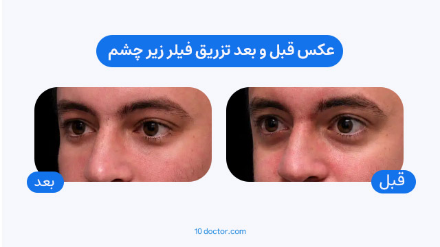 عکس قبل و بعد تزریق فیلر زیر چشم 