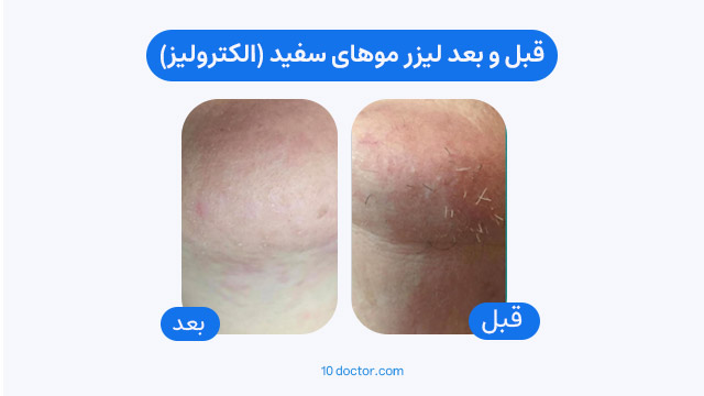 قبل و بعد لیزر موهای سفید (الکترولیز)