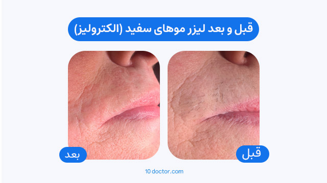 قبل و بعد لیزر موهای سفید (الکترولیز)