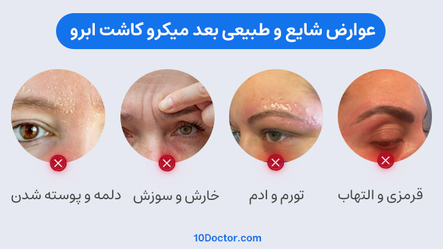 عوارض شایع و طبیعی بعد میکرو کاشت ابرو 