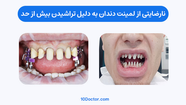 نارضایتی از لمینت دندان به دلیل تراش بیش از حد 