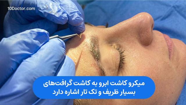 میکرو کاشت ابرو به کاشت گرافت‌های بسیار ظریف و تک‌ تار اشاره دارد. 