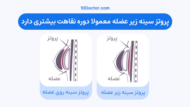 پروتز سينه زير عضله معمولا دوره نقاهت بیشتری دارد.
