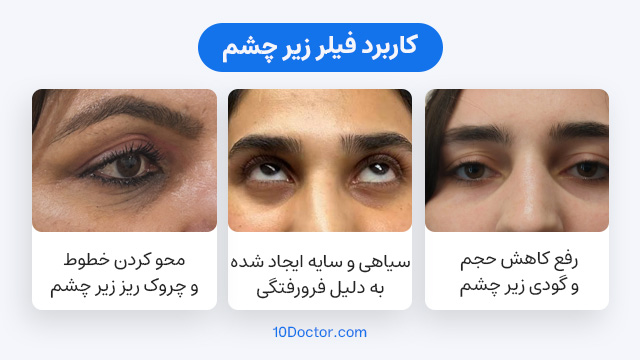 کاربردهای فیلر زیر چشم