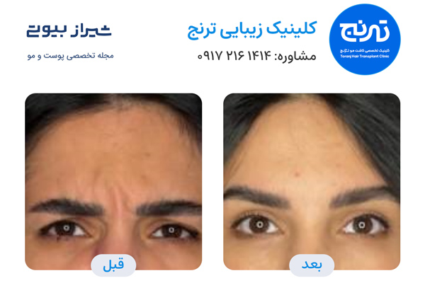 تزریق فیلر زیر چشم در شیراز - نمونه کار قبل و بعد کلینیک ترنج
