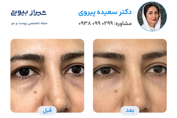 تزریق فیلر زیر چشم در شیراز - نمونه کار قبل و بعد دکتر سعیده پیروی