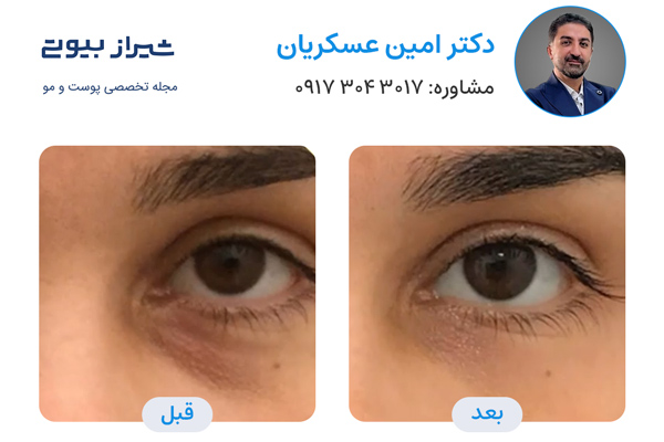 تزریق فیلر زیر چشم در شیراز - نمونه کار قبل و بعد دکتر امین عسکریان