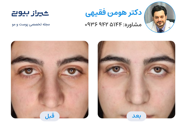 تزریق فیلر زیر چشم در شیراز - نمونه کار قبل و بعد دکتر هومن فقیهی