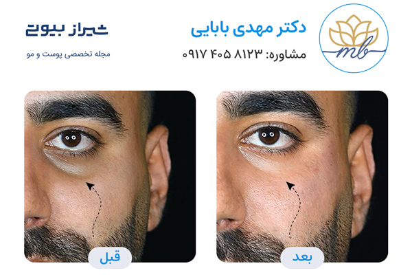 تزریق فیلر زیر چشم در شیراز - نمونه کار قبل و بعد دکتر مهدی بابایی