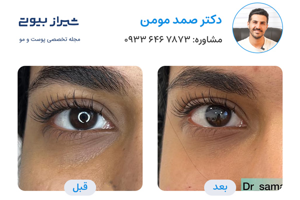 تزریق فیلر زیر چشم در شیراز - نمونه کار قبل و بعد دکتر صمد مومن