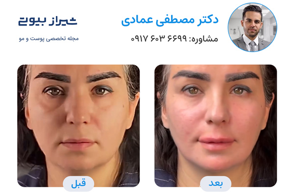 تزریق فیلر زیر چشم در شیراز - نمونه کار قبل و بعد دکتر مصطفی عمادی