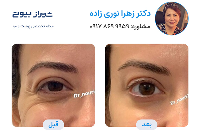 تزریق فیلر زیر چشم در شیراز - نمونه کار قبل و بعد دکتر زهرا نوری زاده