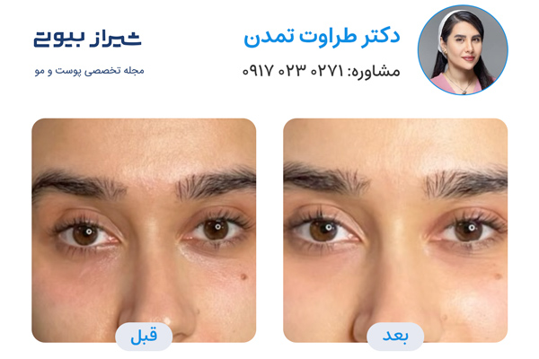 تزریق فیلر زیر چشم در شیراز - نمونه کار قبل و بعد دکتر طراوت تمدن