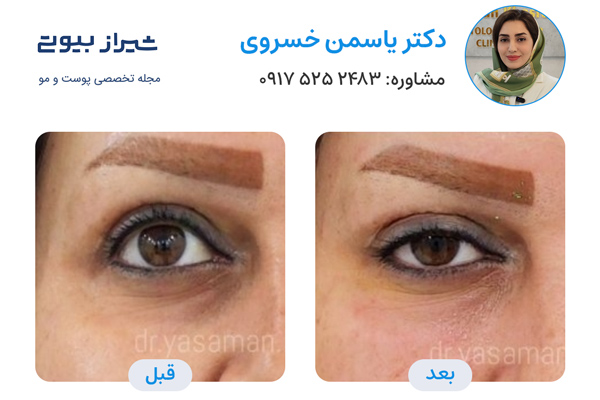 تزریق فیلر زیرچشم در شیراز - دکتر یاسمن خسروی