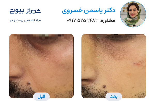 تزریق فیلر زیرچشم در شیراز - دکتر یاسمن خسروی