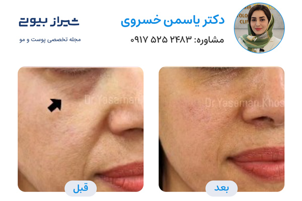 تزریق فیلر زیرچشم در شیراز - دکتر یاسمن خسروی