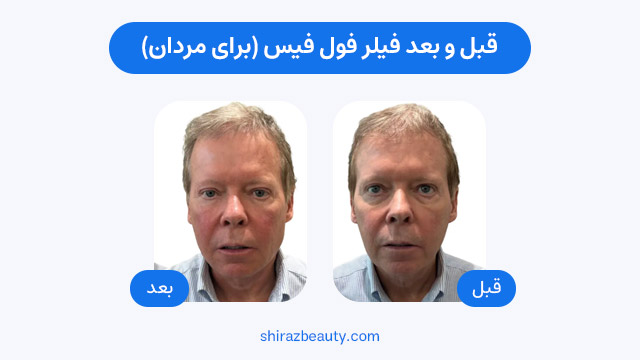 قبل و بعد فیلر فول فیس (برای مردان)