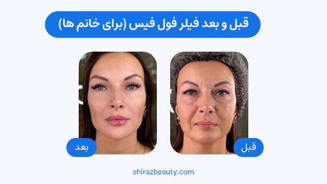 قبل و بعد فیلر فول فیس (برای خانم ها)