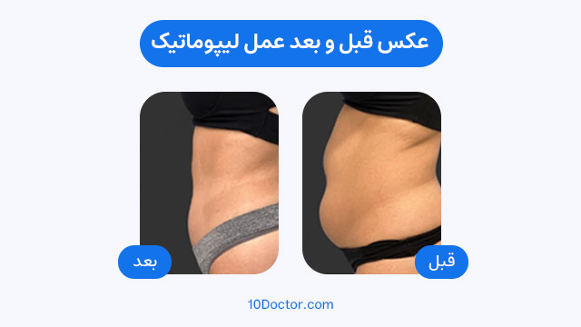 عکس قبل و بعد عمل لیپوماتیک