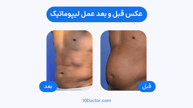 عکس قبل و بعد عمل لیپوماتیک