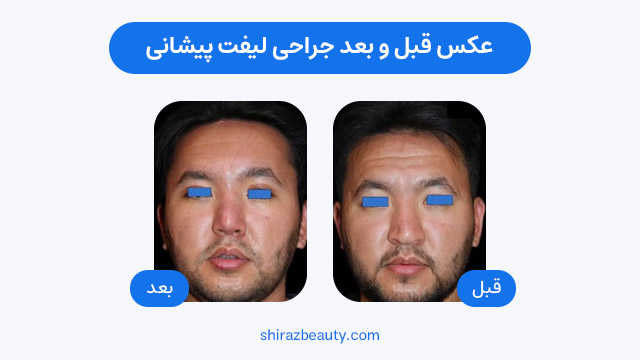 عکس قبل و بعد جراحی لیفت پیشانی
