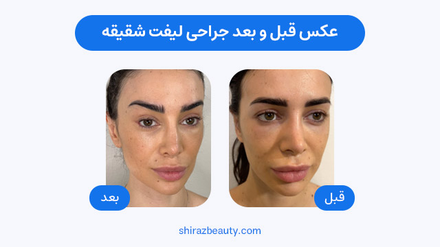 عکس قبل و بعد جراحی لیفت شقیقه
