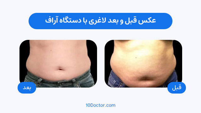 عکس قبل و بعد لاغری با دستگاه آراف