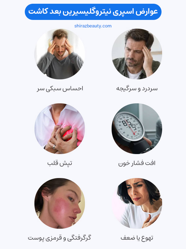 عوارض اسپری نیتروگلیسیرین بعد کاشت مو